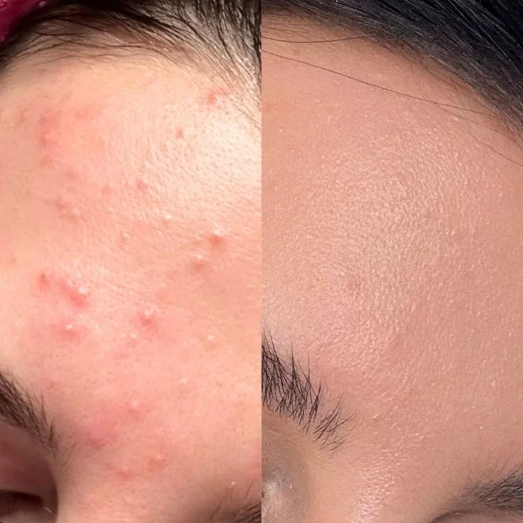 Anti acne (Face serum)