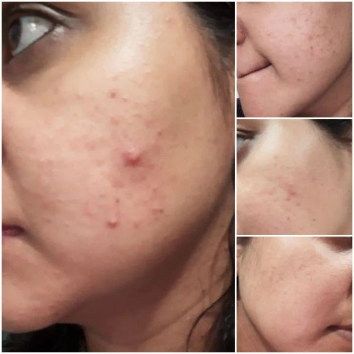 Anti acne (Face serum)