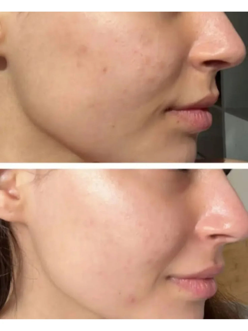 Ice Facial Kit