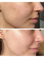 Ice Facial Kit